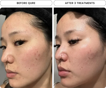 Micro-Infusion Facial System