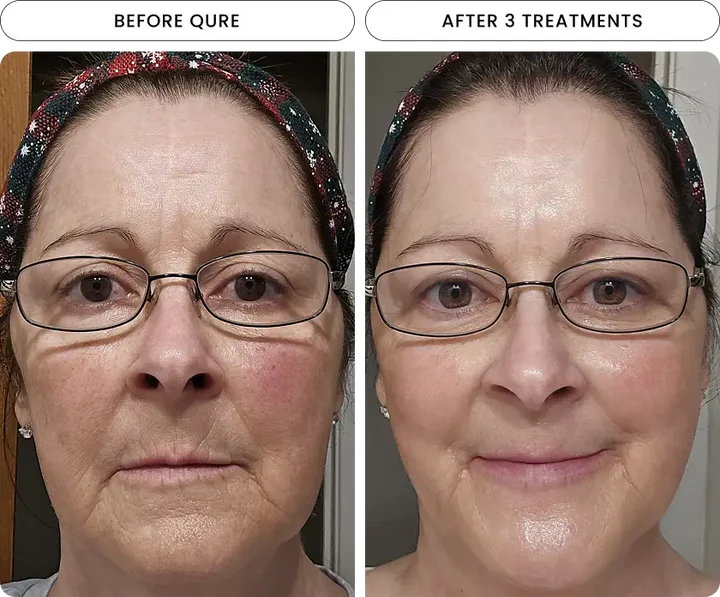 Micro-Infusion Facial System